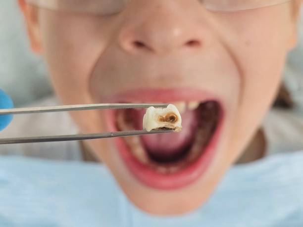 Best Emergency Tooth Extraction in Hayneville, AL